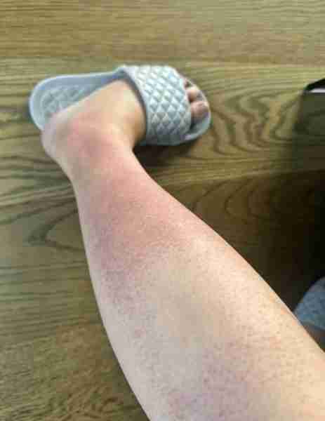 I'm 18 weeks pregnant and got this horrible rash on my legs. Itchy and bumpy skin. Can't get an OB a...