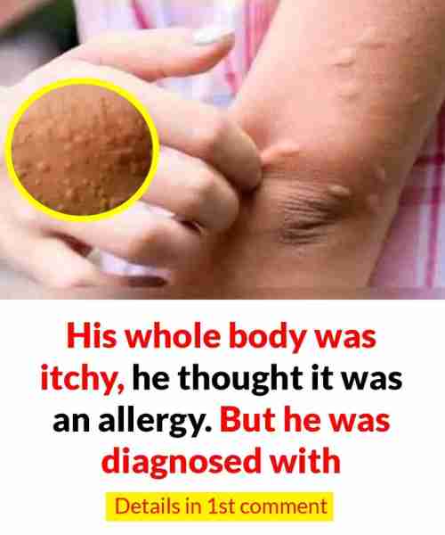 His whole body was itchy, he thought it was an allergy and was diagnosed...See More in comments 👇